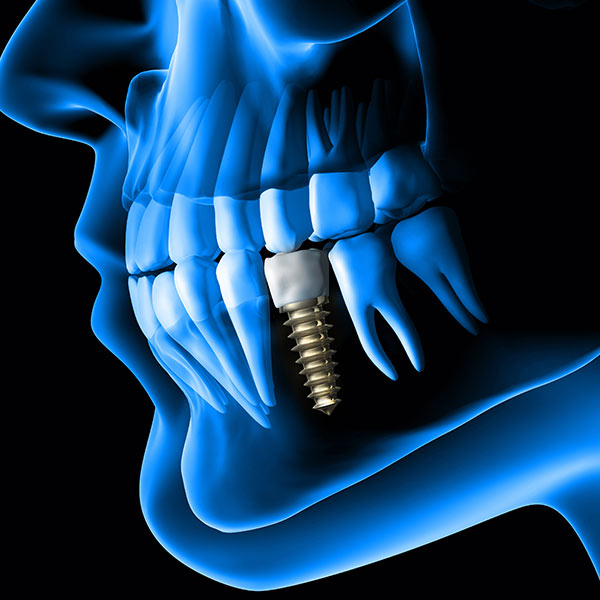 dental implants Rochester, NY
