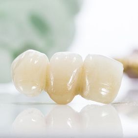 tooth replacement or bridge in rochester, NY
