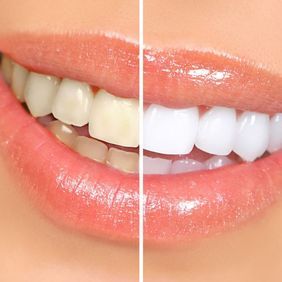 picture of smile before/after teeth whitening in rochester, NY