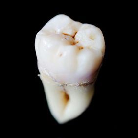 pulled tooth