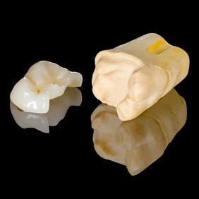 ceramic inlay services in Rochester, NY - Torrado Dental