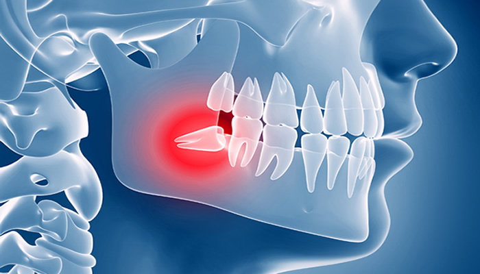 tooth extraction in Rochester, NY - Torrado Dental